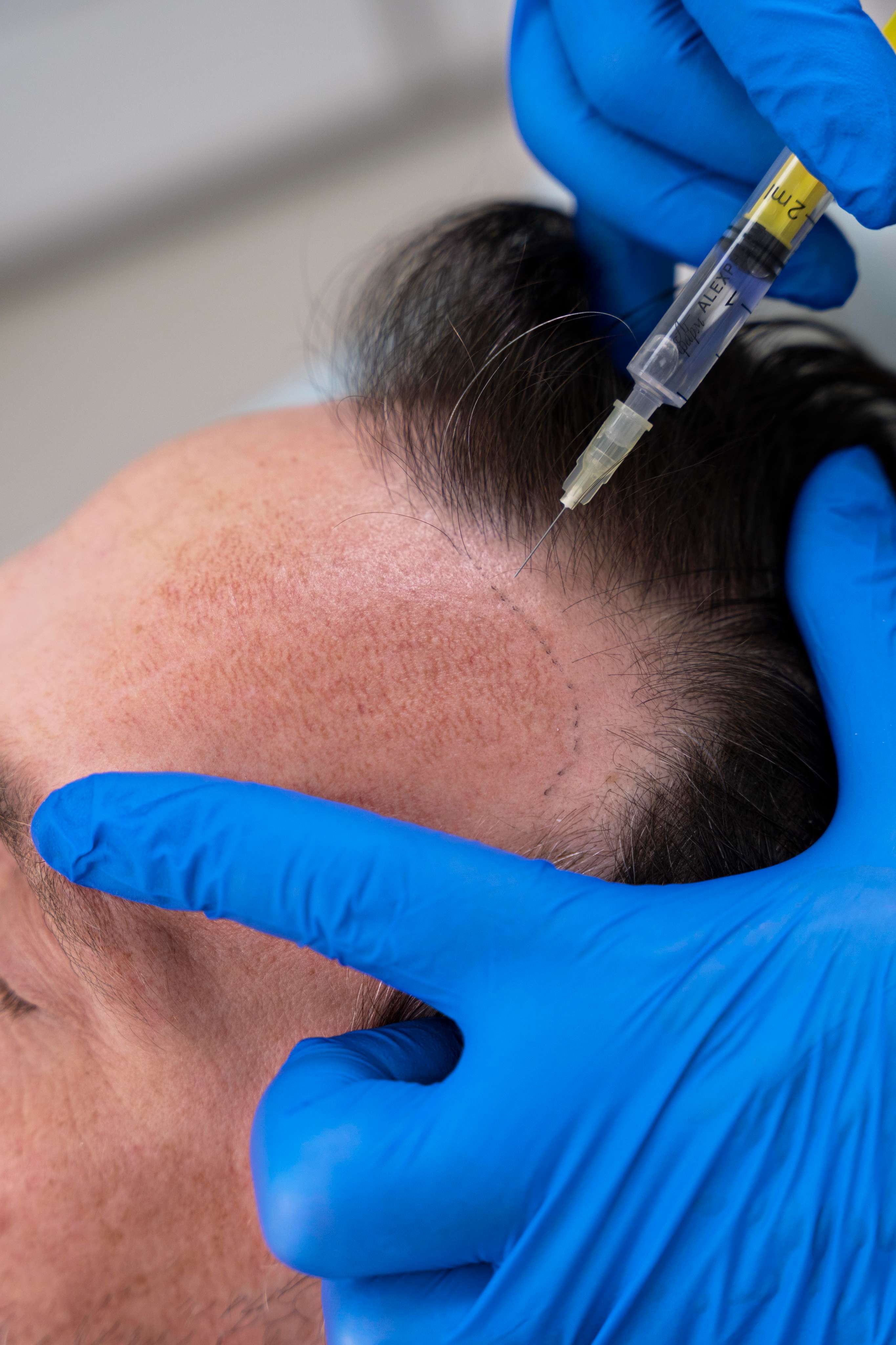 Polynucleotide hair loss treatment being administered